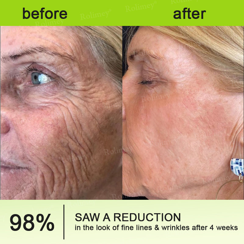 ⌛💫🪄Made and shipped from Australia 💫Rolimey® Botox & Vita-A Retinol Shot Wrinkle-Lift Tightening cream - Last Day Promotion 70% OFF