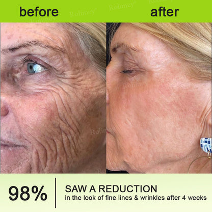 ⌛💫🪄Made and shipped from Australia 💫Rolimey® Botox & Vita-A Retinol Shot Wrinkle-Lift Tightening cream - Last Day Promotion 70% OFF