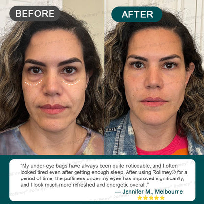 ⏰🔥🇦🇺 LAST DAY!🌟✨Rolimey® Botox & Stem Cell Wrinkle-Lift Tightening Cream