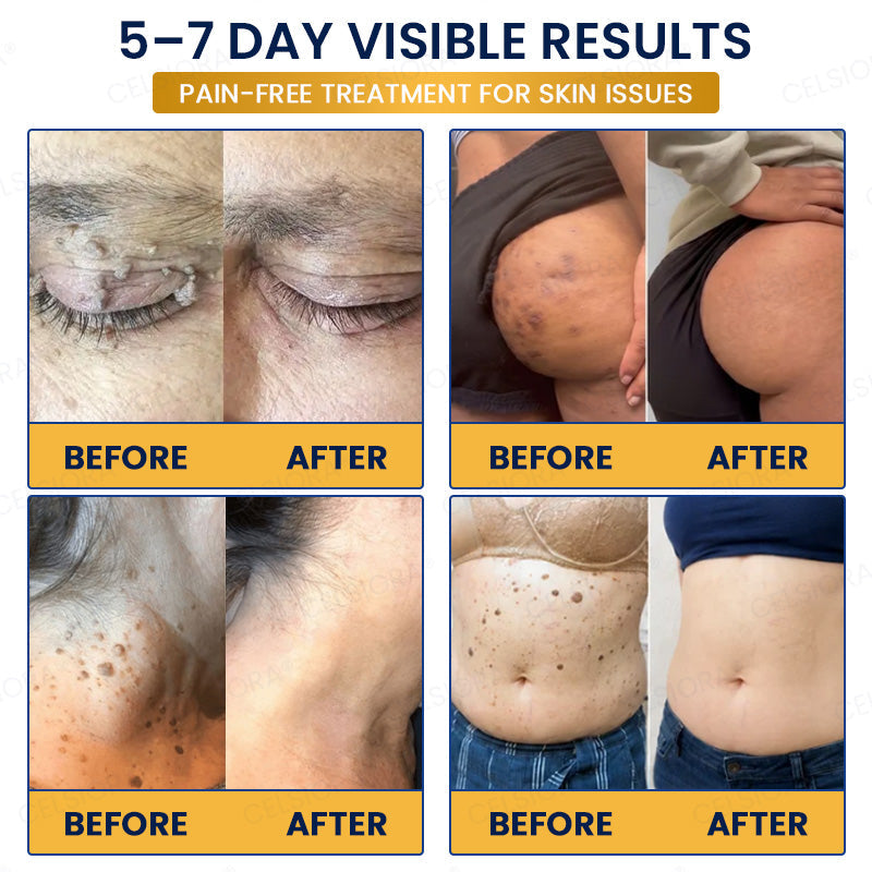 🎊✨GFOUK® 7-Day MicroNeedle Wart & Skin Tag Removal Patch